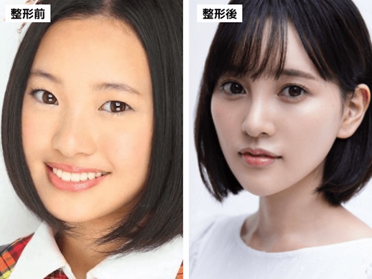 haruka kodama plastic surgery